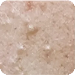 白ニキビ（コメド）