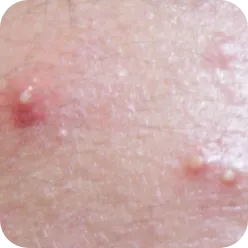 黄ニキビ （嚢胞ニキビ）