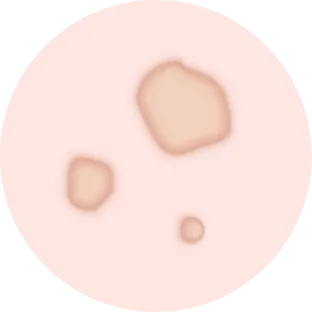 凹み（クレーター）タイプ